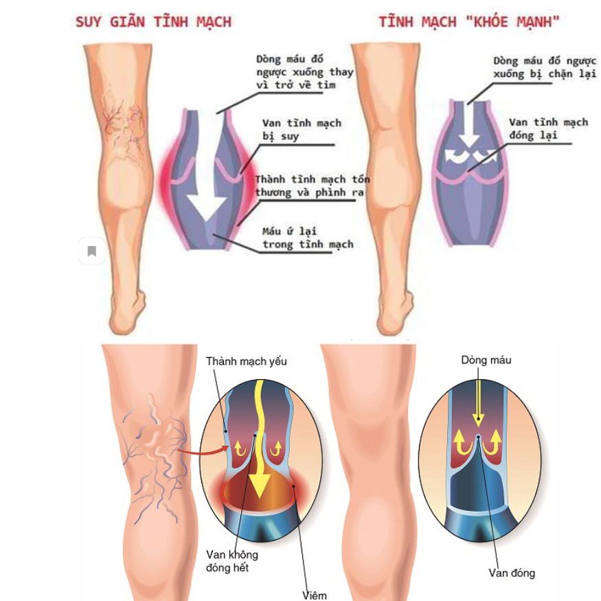 Máy nén ép trị liệu suy giãn tĩnh mạch chân Kachi MK394_thumbnail_6