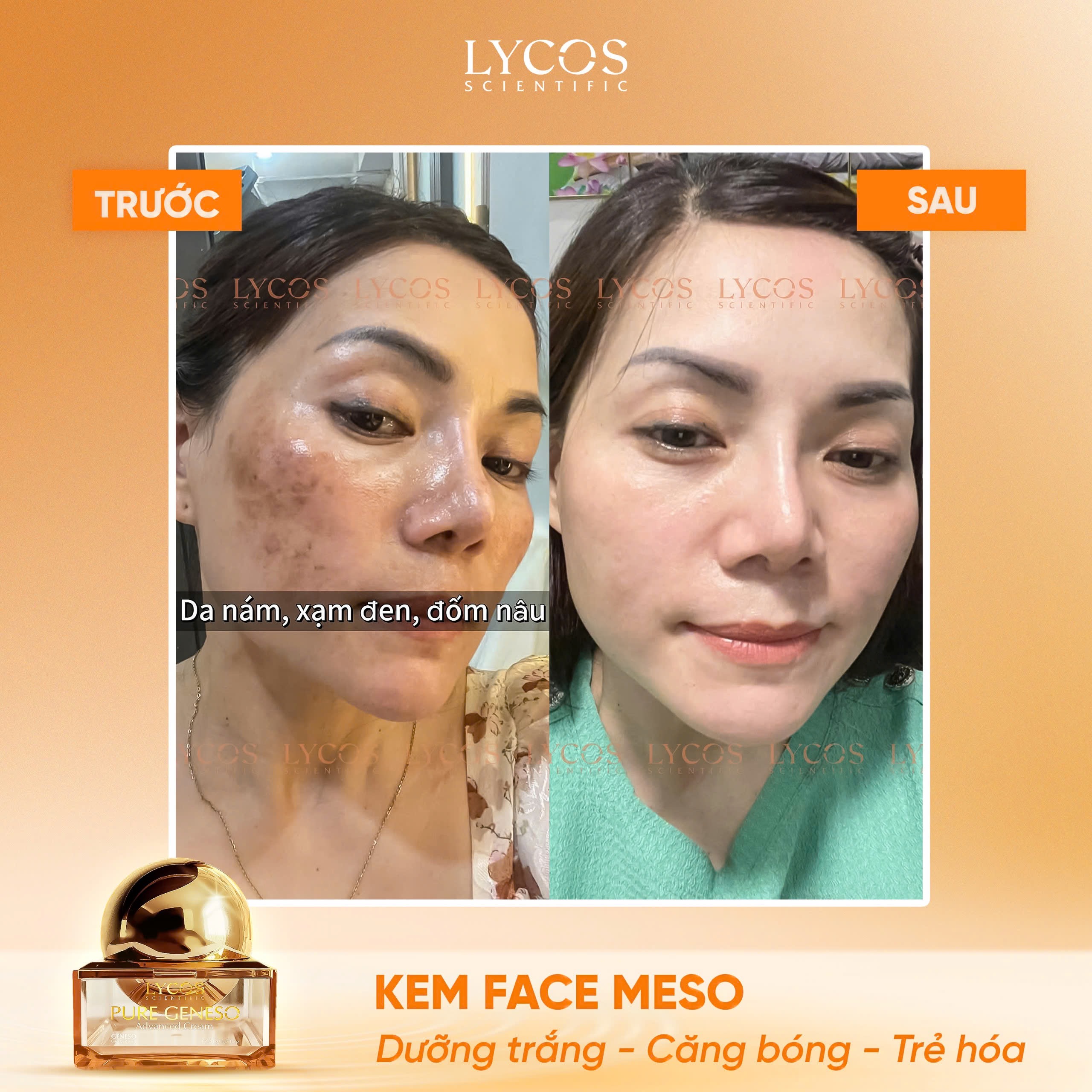 Combo Mờ Nám Sáng Khỏe 4 Bước Lycos – Peel Da, Gel Dưỡng Ẩm, Kem Face Meso, Kem Nám Đêm – Giảm Thâm, Đều Màu, Trẻ Hóa Da_thumbnail_3