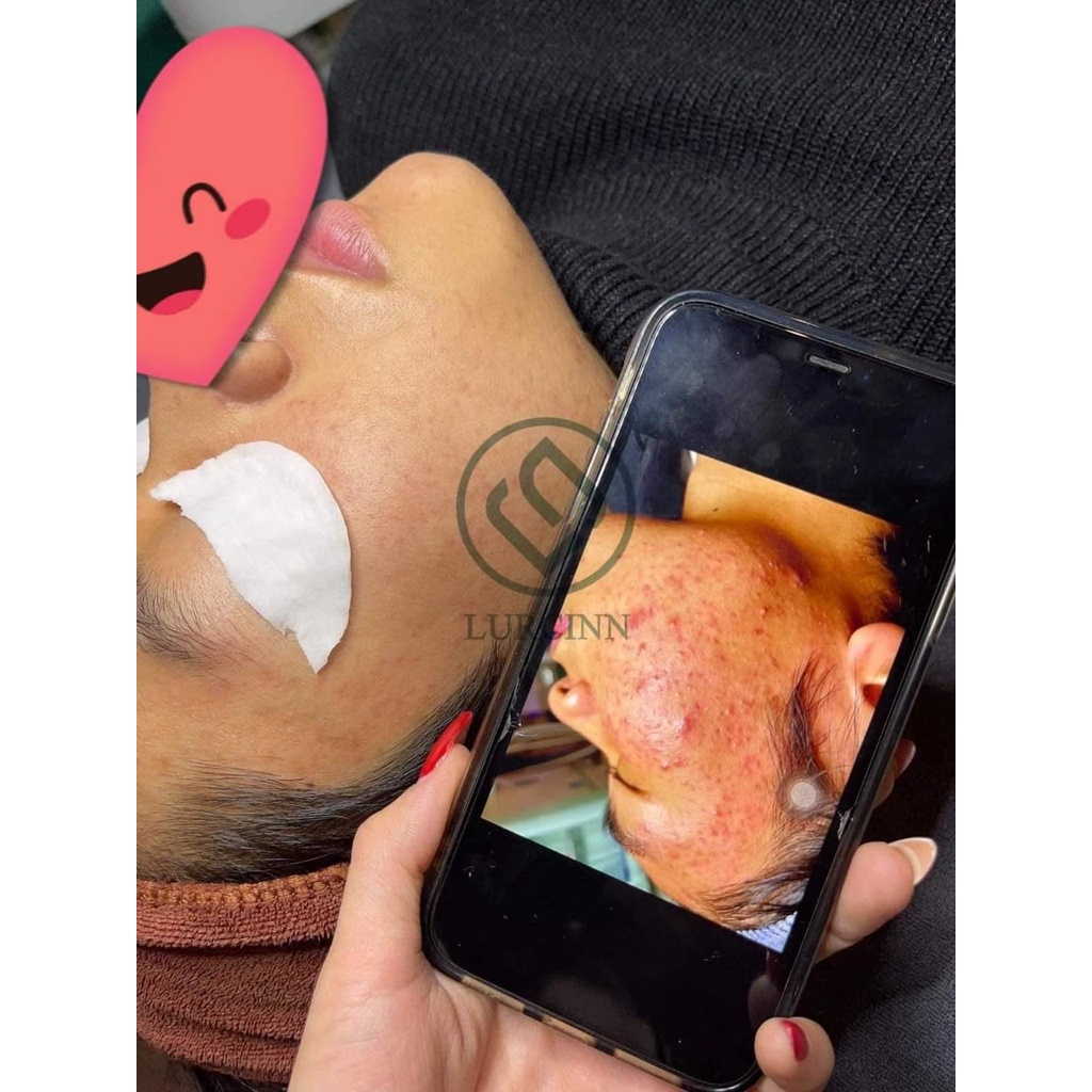Serum Chống Tái Mụn Luricnn Prevent Acne For Oily Skin 30g_thumbnail_5