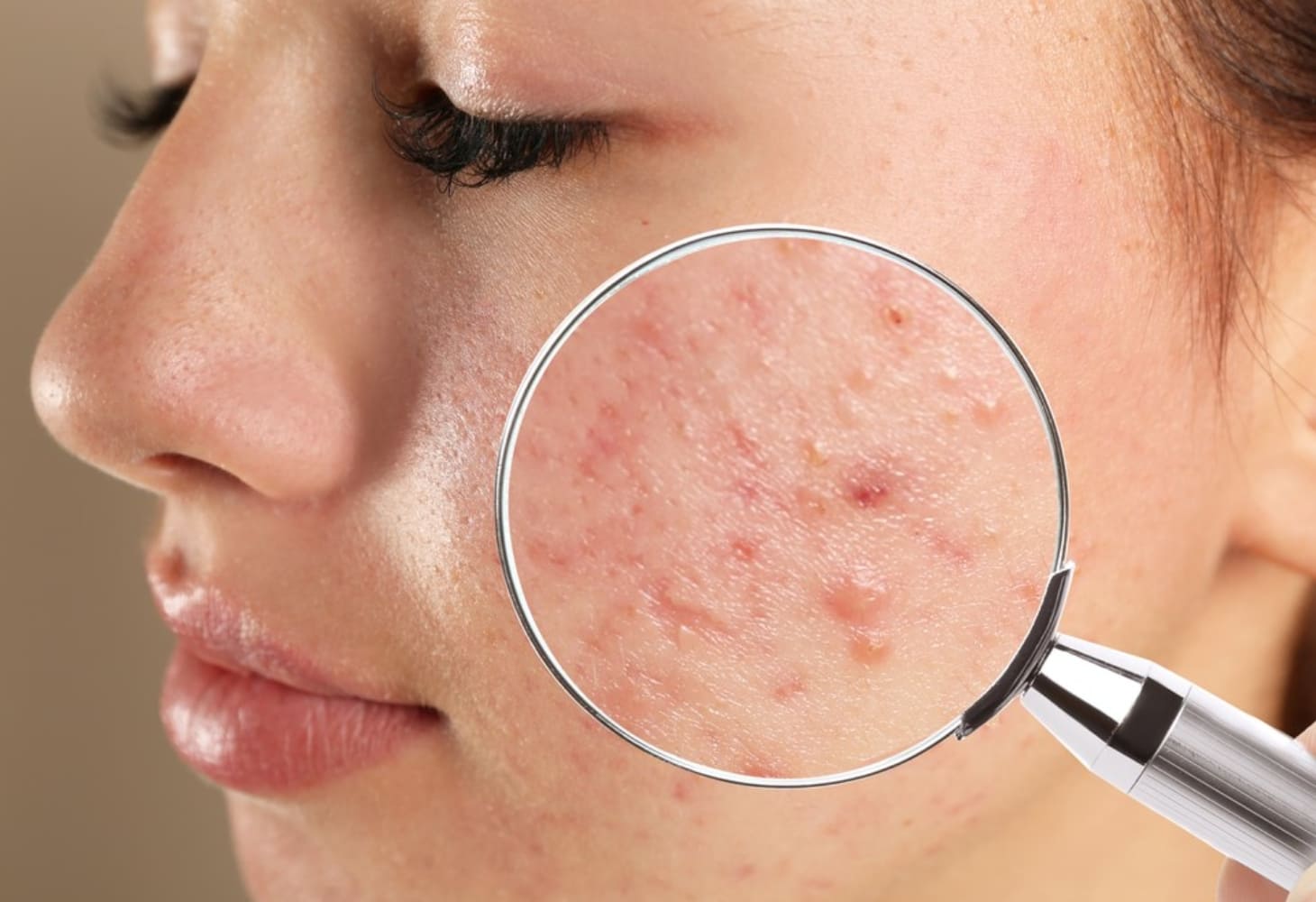 Dấu hiệu nhận biết mụn nội tiết và cách trị mụn từ bên trong