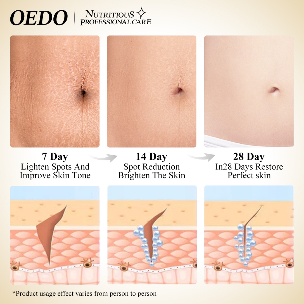 OEDO Rose Stretch Marks Cream 40g_thumbnail_4