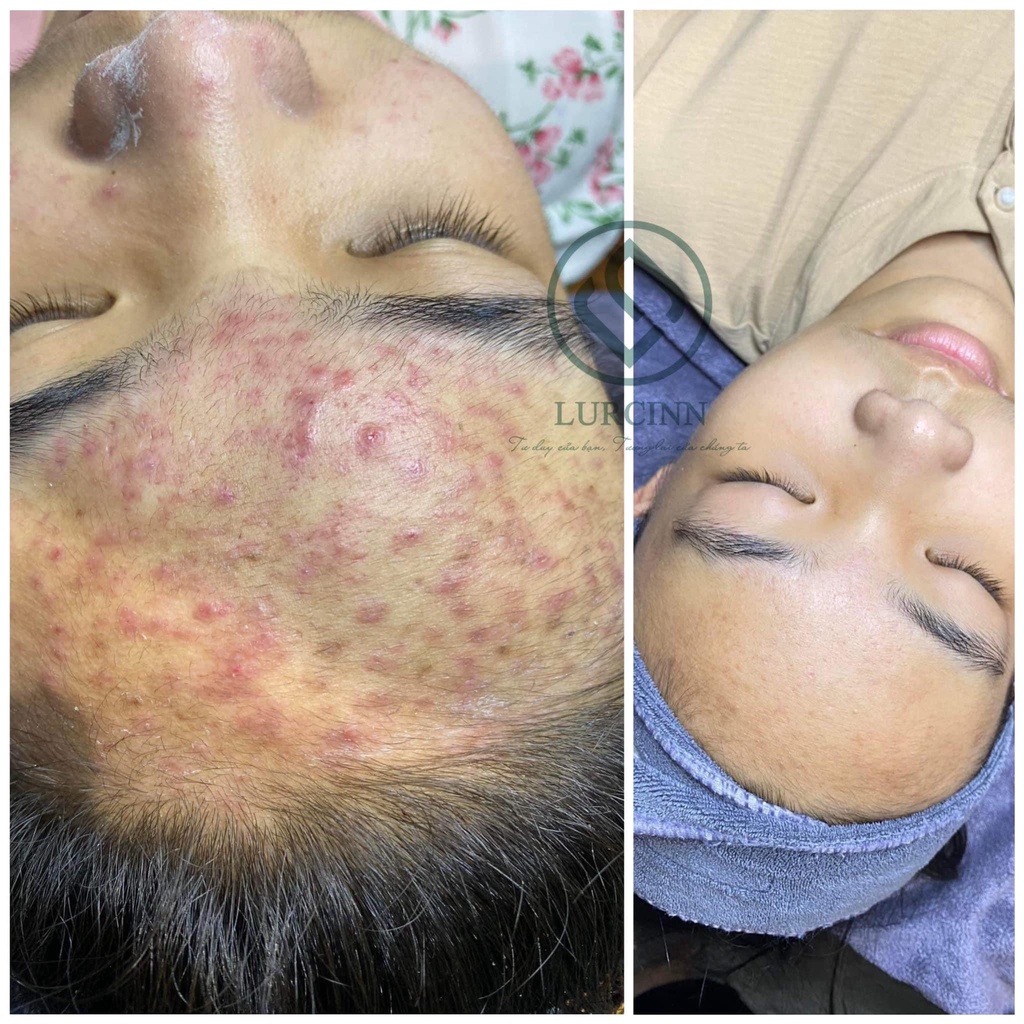 Serum Chăm Sóc Da Mụn Mờ Thâm LURCINN SAPANZI Prevent Acne 10ml_thumbnail_10