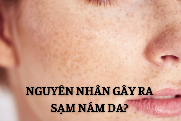 chăm sóc da sạm nám
