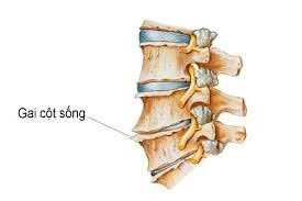 Vôi hóa cột sống – Nguyên nhân, triệu chứng và phương pháp điều trị hiệu quả_thumbnail_2