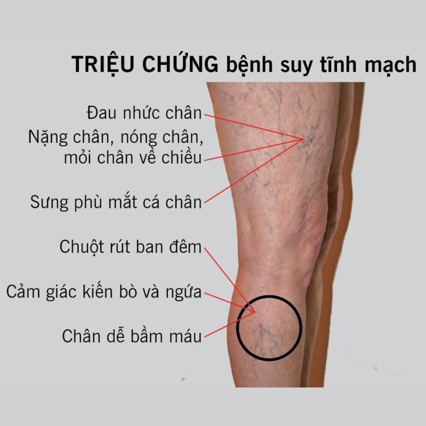 Máy nén ép trị liệu suy giãn tĩnh mạch chân Kachi MK394_thumbnail_4