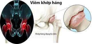 Viêm khớp háng – Cơn đau âm ỉ khiến bạn khó khăn trong từng bước đi